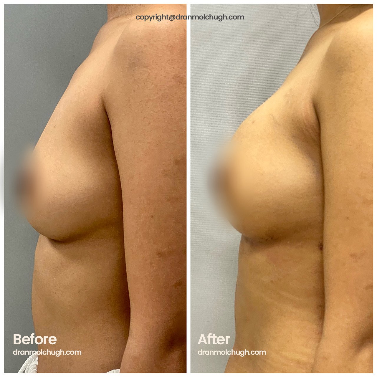 Breast Fat transfer