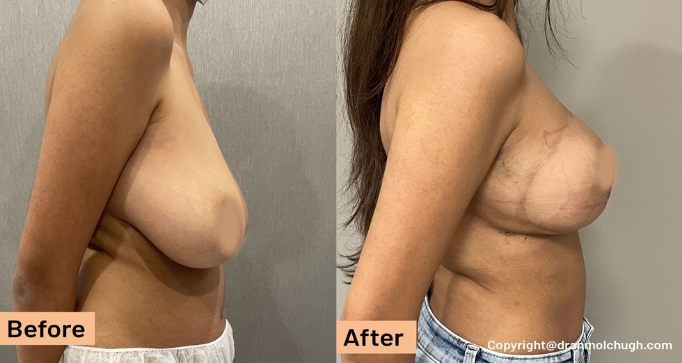 Breast Lift Surgery