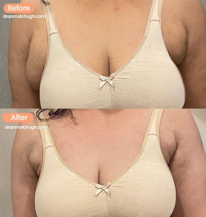 Axillary Breast Fat Pad
