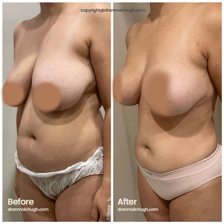 Breast Reduction Surgery